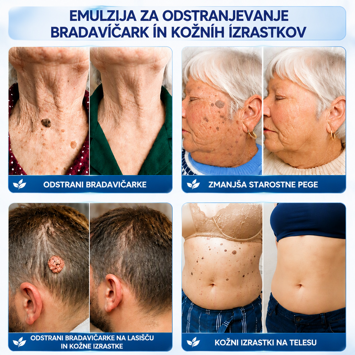 HISKIN® 7-dnevna krema proti kožnim izrastkom in pigmentnim madežem (Neboleča nega – brez brazgotin)🎉