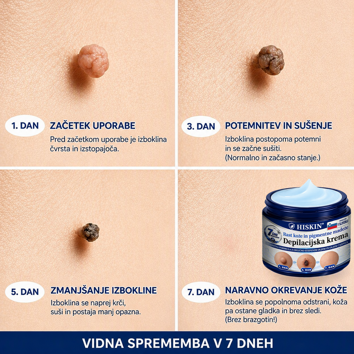 HISKIN® 7-dnevna krema proti kožnim izrastkom in pigmentnim madežem (Neboleča nega – brez brazgotin)🎉